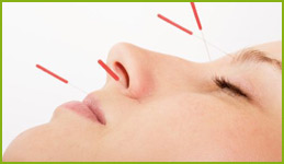Acupuncture needles in the face