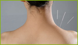 Acupuncture needles in the shoulder